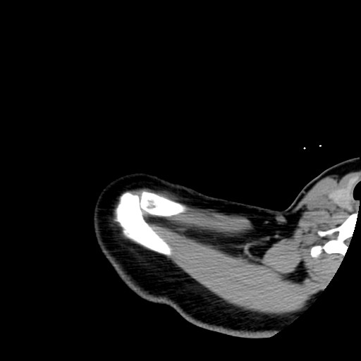 Calcific tendinitis of the infraspinatus tendon (Radiopaedia 87256-103539 B 11).jpg
