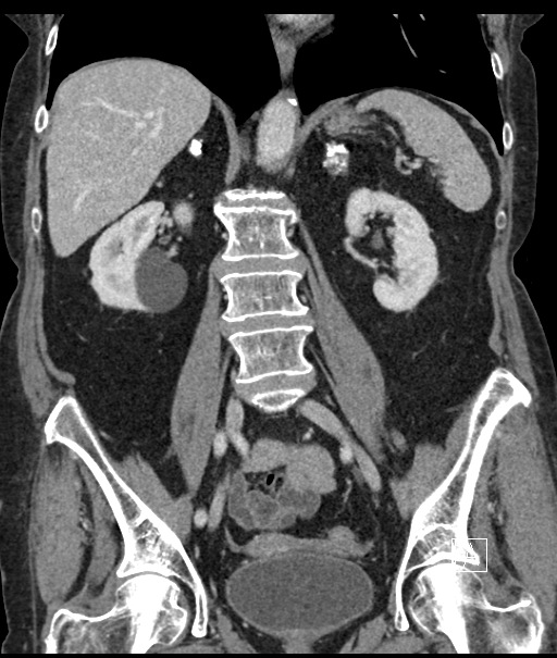 Calcified adrenal glands and Spigelian hernia (Radiopaedia 49741-54988 B 67).jpg