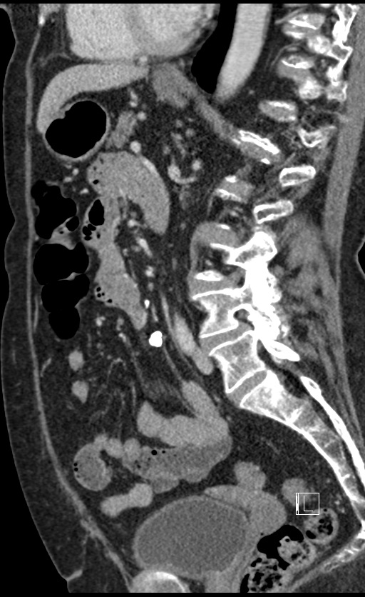 Calcified adrenal glands and Spigelian hernia (Radiopaedia 49741-54988 C 73).jpg