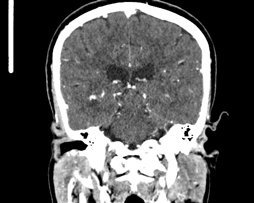 File:Calcified cerebral hydatid cyst (Radiopaedia 65603-74717 C 44).jpg