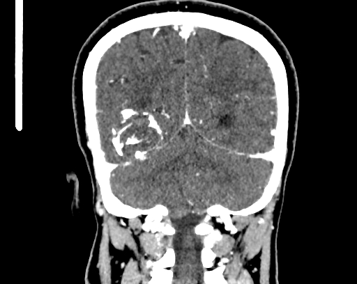 Calcified cerebral hydatid cyst (Radiopaedia 65603-74717 C 56).jpg