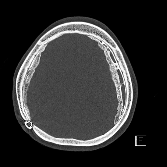 Calcified chronic subdural hematoma (Radiopaedia 77374-89492 Axial bone window 100).jpg