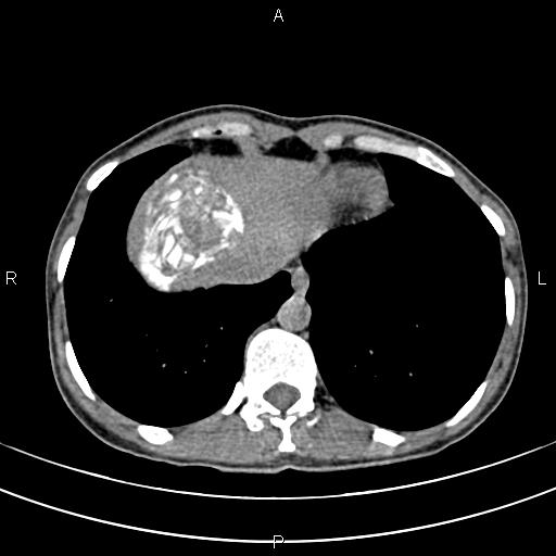 File:Calcified hepatic hydatid cyst (Radiopaedia 83870-99072 Axial non-contrast 15).jpg