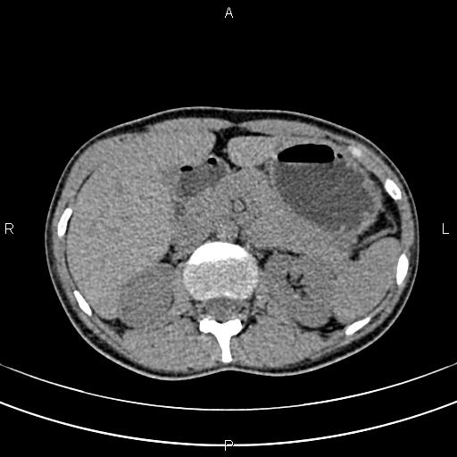 File:Calcified hepatic hydatid cyst (Radiopaedia 83870-99072 Axial non-contrast 58).jpg