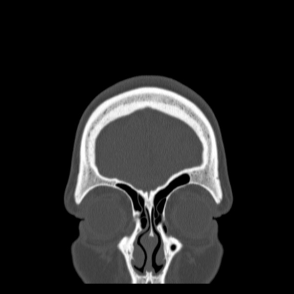 Calvarial osteoma (Radiopaedia 36520-38079 C 14).jpg