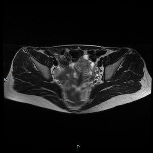 File:Canal of Nuck cyst (Radiopaedia 55074-61448 Axial T2 8).jpg