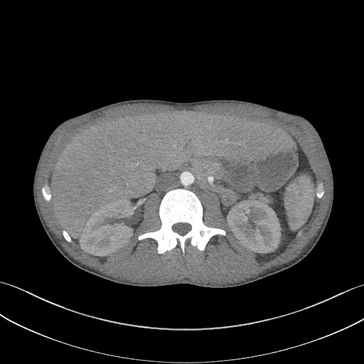 Cannonball metastases - testicular choriocarcinoma (Radiopaedia 84510-99891 B 121).jpg
