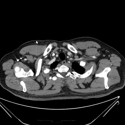 File:Cannonball pulmonary metastases (Radiopaedia 67684-77101 D 22).jpg