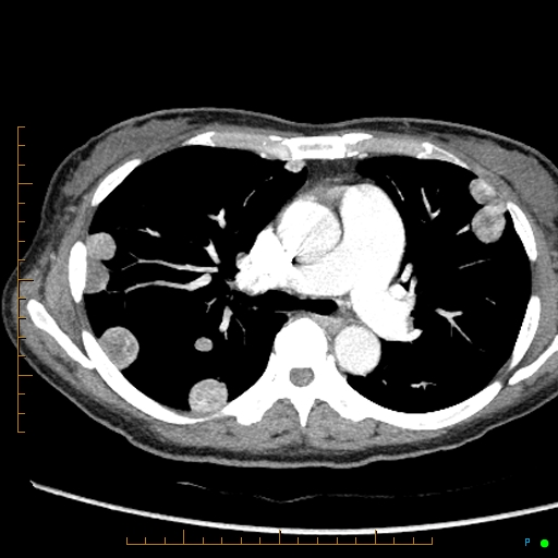Canonball lung metastasis (Radiopaedia 77634-89837 B 39).jpg