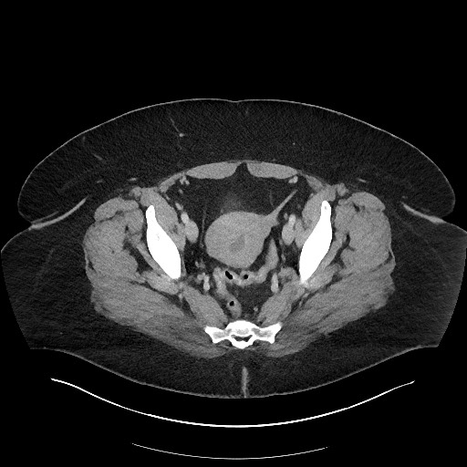 Carcinoid tumor - terminal ileum (Radiopaedia 60931-68739 A 114).jpg
