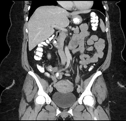 Carcinoid tumor - terminal ileum (Radiopaedia 60931-68739 B 40).jpg