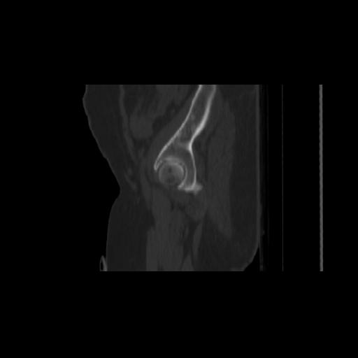 Carcinoma cervix- brachytherapy applicator (Radiopaedia 33135-34173 Sagittal bone window 15).jpg