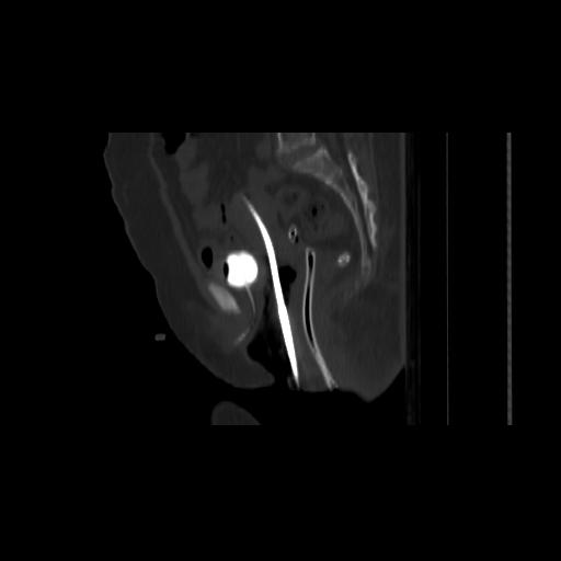 File:Carcinoma cervix- brachytherapy applicator (Radiopaedia 33135-34173 Sagittal bone window 88).jpg