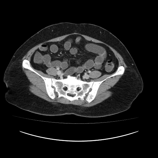 Carcinoma colon - hepatic flexure (Radiopaedia 19461-19493 A 95).jpg
