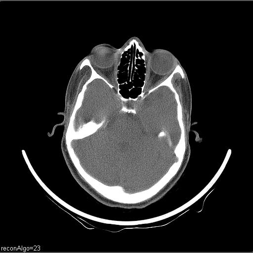 Carcinoma of the maxillary antrum (Radiopaedia 53805-59888 Axial non-contrast 72).jpg