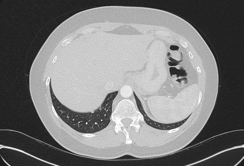 File:Cardiac sarcoidosis (Radiopaedia 74548-85534 Axial lung window 82).jpg