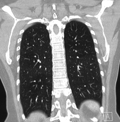 Cardiac sarcoidosis (Radiopaedia 74548-85534 Coronal lung window 54).jpg