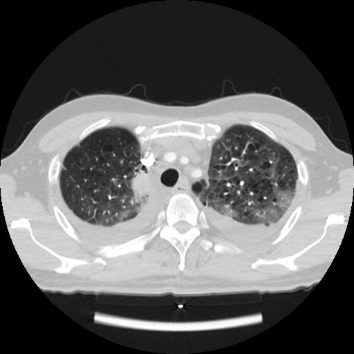 Cardiac tamponade (Radiopaedia 78607-91368 Axial lung window 14).jpg
