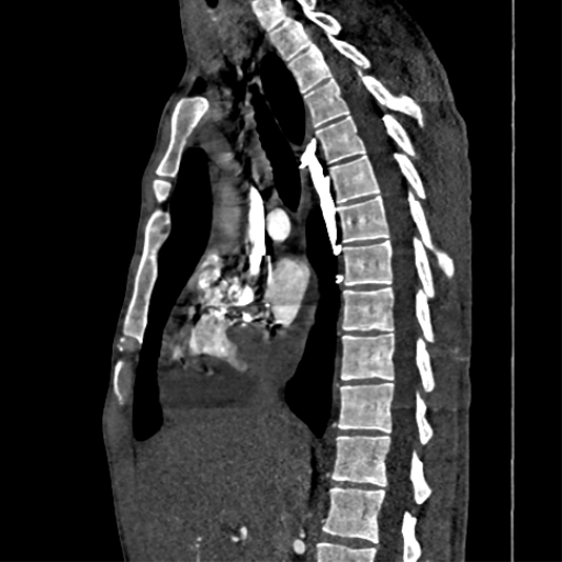 File:Cardiac tumor - undifferentiated pleomorphic sarcoma (Radiopaedia 45844-50134 Coronal non-contrast 71).png