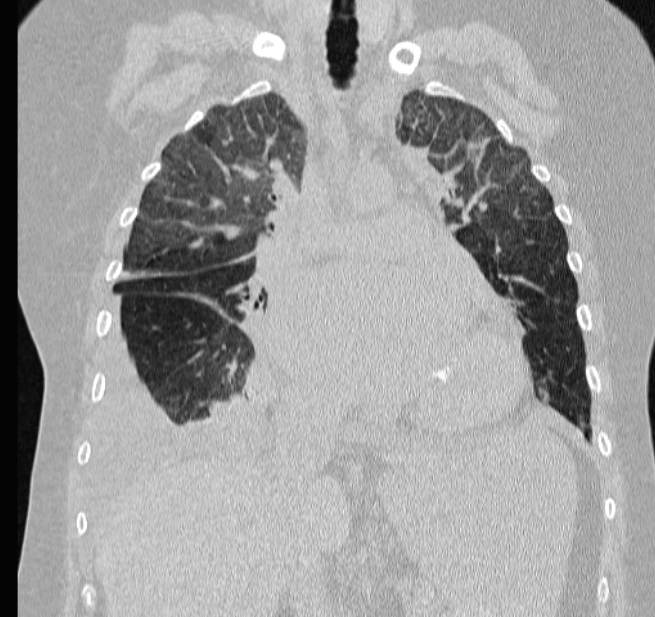 Cardiogenic pulmonary edema (Radiopaedia 29213-29609 Coronal lung window 29).jpg