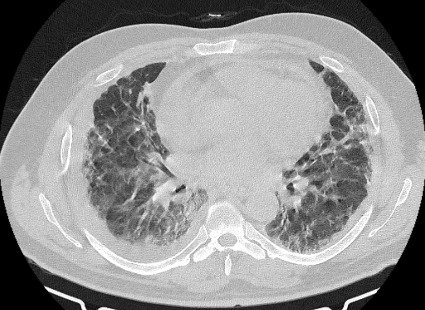 Cardiogenic pulmonary edema (Radiopaedia 68180-77678 Axial lung window 56).jpg