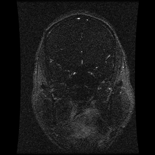 Carotid arterial dissection with acute cerebral infarction (Radiopaedia 26636-26784 MRV 115).jpg