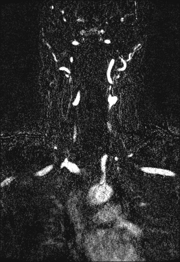 Carotid artery dissection (Radiopaedia 28441-28689 Coronal MRA 41).jpg