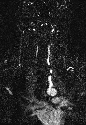 Carotid artery dissection (Radiopaedia 28441-28689 Coronal MRA 63).jpg