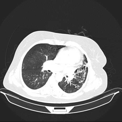 File:Carotid body tumor (Radiopaedia 21021-20948 Axial lung window 20).jpg