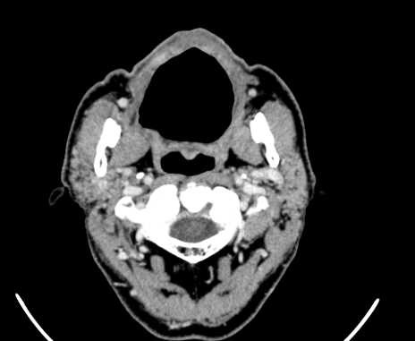Carotid body tumor (Radiopaedia 61750-69757 Axial Post contrast 15).jpg