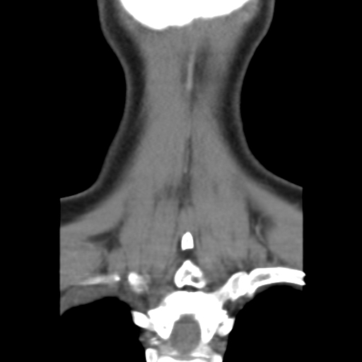 File:Carotid body tumor (paraganglioma) (Radiopaedia 38586-40729 B 38).jpg