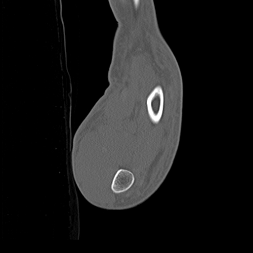 File:Carpo-metacarpal fracture-dislocations with hamatum split fracture (Radiopaedia 18482-18343 Sagittal bone window 31).jpg