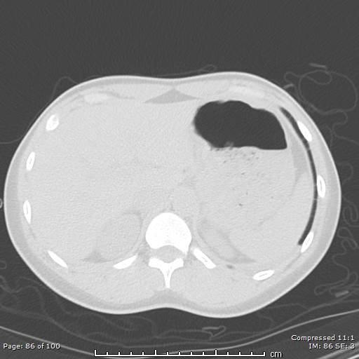 Catamenial pneumothorax (Radiopaedia 54382-60600 Axial non-contrast 86).jpg