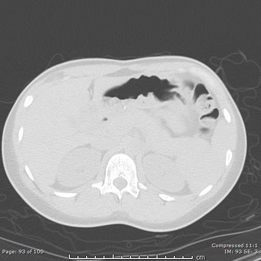 Catamenial pneumothorax (Radiopaedia 54382-60600 Axial non-contrast 93).jpg