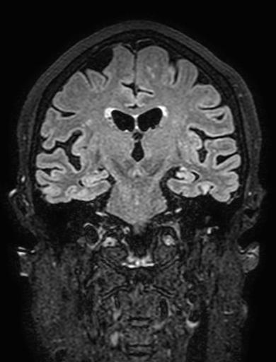 Cavernous hemangioma of the cerebellar falx (Radiopaedia 73025-83724 Coronal FLAIR 185).jpg