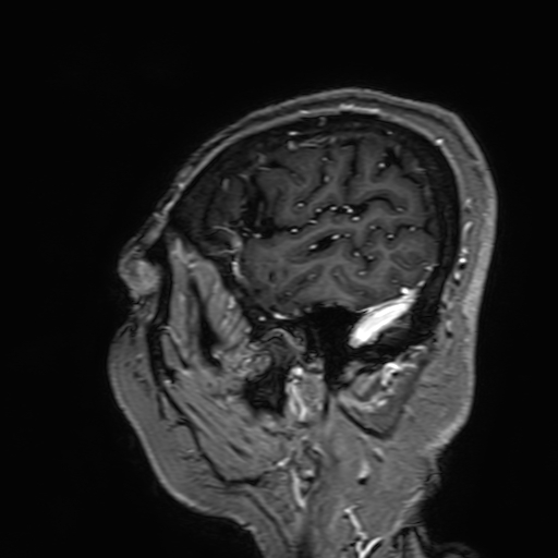 Cavernous hemangioma of the cerebellar falx (Radiopaedia 73025-83724 Sagittal T1 C+ 29).jpg