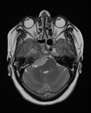 File:Cavernous sinus meningioma (Radiopaedia 63682-72367 Axial T2 7).jpg
