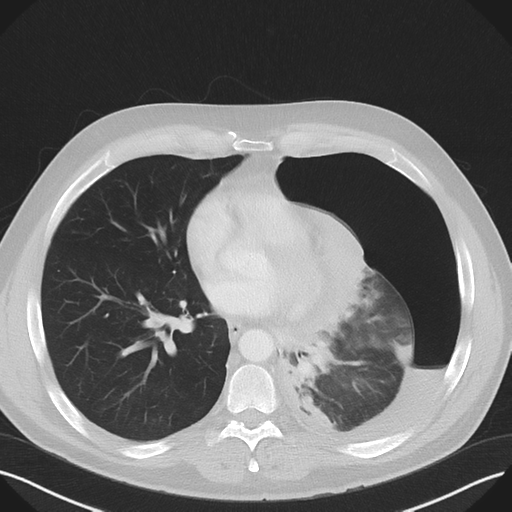 File:Cavitating pneumonia complicated by pneumothorax (Radiopaedia 48149-52994 Axial lung window 41).png
