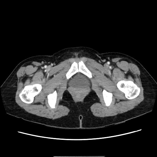 Cecal adenocarcinoma (Radiopaedia 75909-87331 A 89).jpg