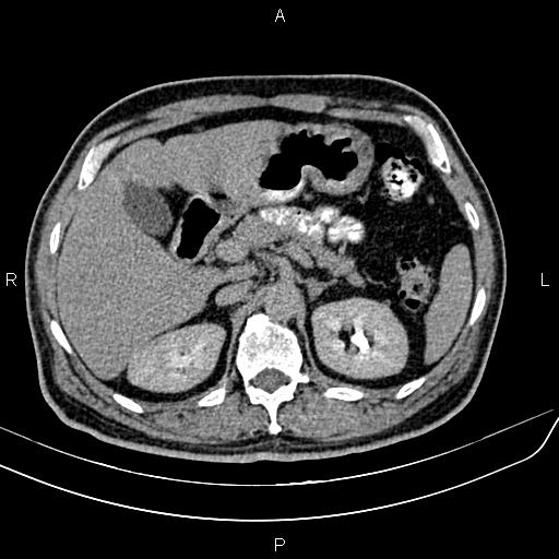 File:Cecal cancer with appendiceal mucocele (Radiopaedia 91080-108651 Axial C+ delayed 12).jpg