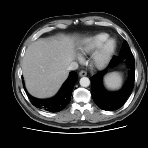 File:Cecal mass causing appendicitis (Radiopaedia 59207-66531 A 14).jpg
