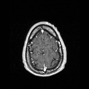 Central-variant posterior reversible encephalopathy syndrome (PRES) (Radiopaedia 43880-47358 Axial T1 C+ 152).jpg