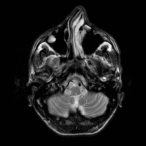 File:Central-variant posterior reversible encephalopathy syndrome (PRES) (Radiopaedia 43880-47359 Axial T2 2).jpg
