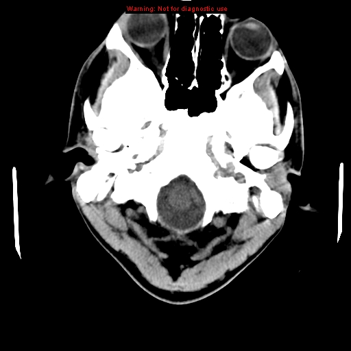 File:Central nervous system vasculitis (Radiopaedia 8410-9234 Axial non-contrast 3).jpg