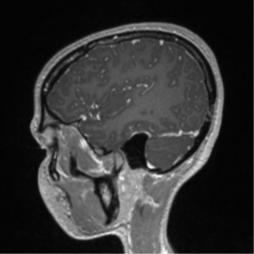 Central neurocytoma (Radiopaedia 37664-39557 Sagittal T1 C+ 23).png