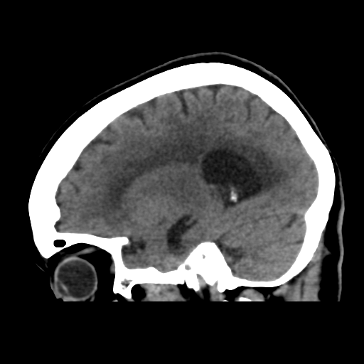 File:Central neurocytoma (Radiopaedia 65317-74346 C 18).png
