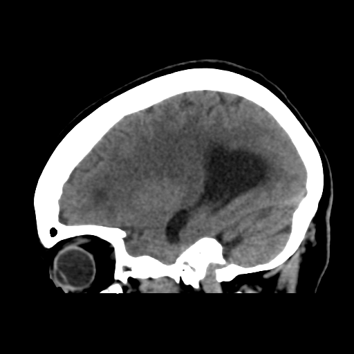 File:Central neurocytoma (Radiopaedia 65317-74346 C 38).png