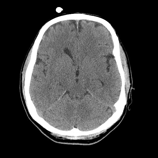 File:Central neurocytoma (Radiopaedia 68725-78432 Axial non-contrast 19).jpg