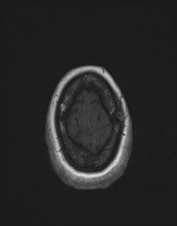 Central neurocytoma (Radiopaedia 84497-99872 Axial T1 173).jpg