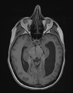 File:Central neurocytoma (Radiopaedia 84497-99872 Axial T1 81).jpg